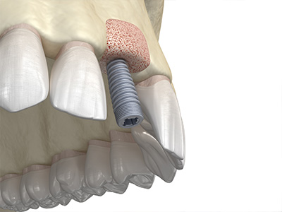 Advanced Dental Concepts | Sinus Lift, Bone Grafting and Veneers