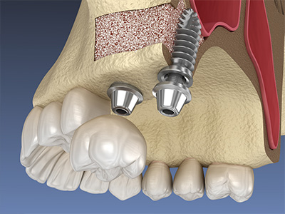 Advanced Dental Concepts | Dental Bridges, Ceramic Crowns and Oral Cancer Screening