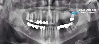 Advanced Dental Concepts | Extractions, Pediatric Dentistry and Dental Fillings