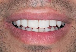 Advanced Dental Concepts | Bone Grafting, Dental Bridges and Sedation Dentistry