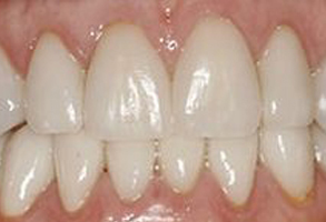 Advanced Dental Concepts | Veneers, Bone Grafting and Preventative Program