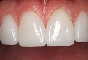 Advanced Dental Concepts | Bone Grafting, Extractions and Dental Fillings