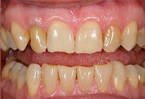 Advanced Dental Concepts | Periodontal Treatment, Bone Grafting and Dentures