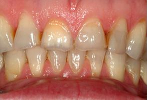 Advanced Dental Concepts | Pediatric Dentistry, Ceramic Crowns and Oral Cancer Screening