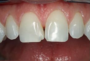 Advanced Dental Concepts | Oral Cancer Screening, Implant Dentistry and Extractions